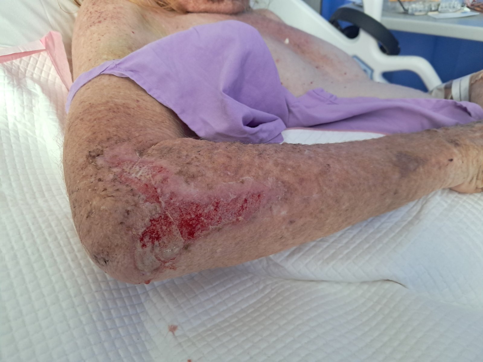 Ash is in hospital
