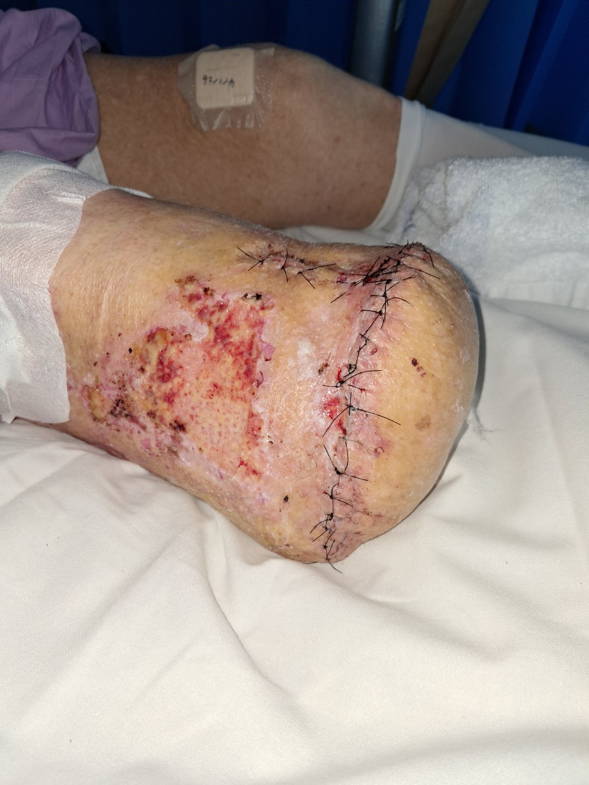 Ash is in hospital