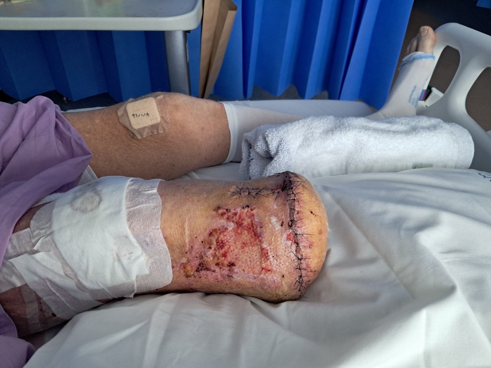 Ash is in hospital