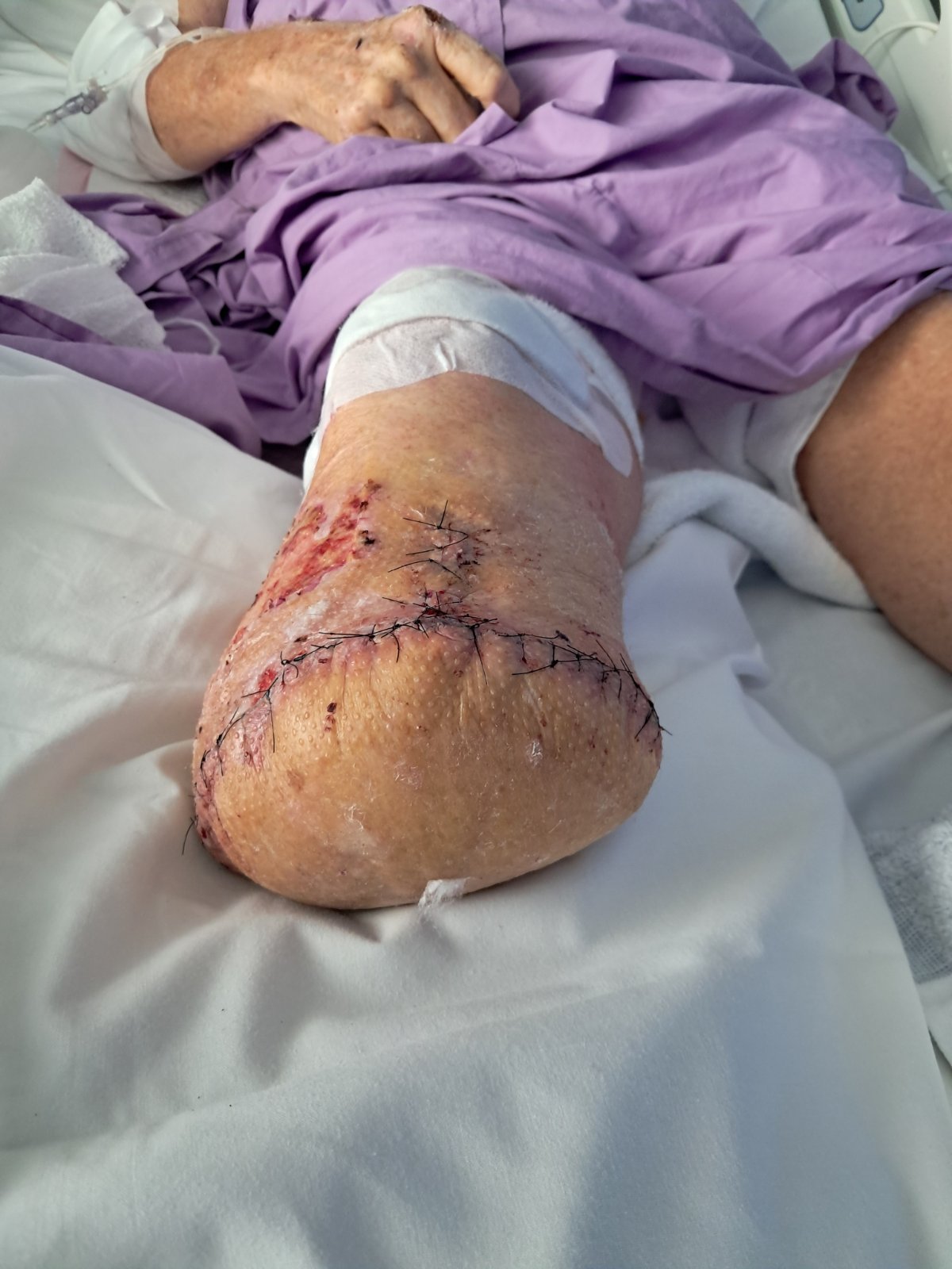 Ash is in hospital