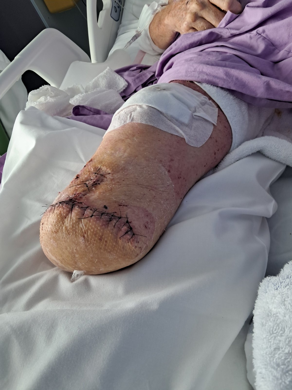 Ash is in hospital