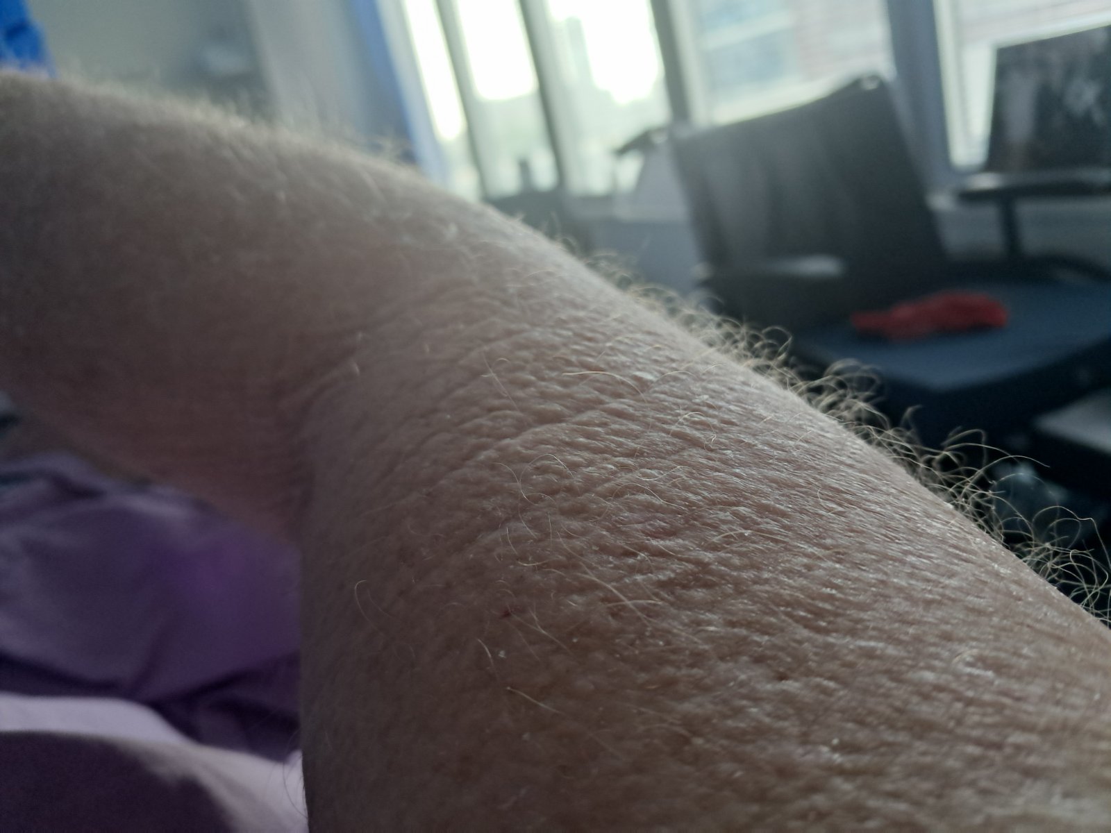 Ash is in hospital
