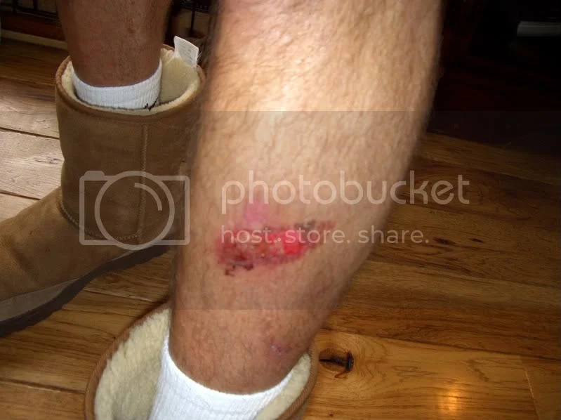muffler burn pictures