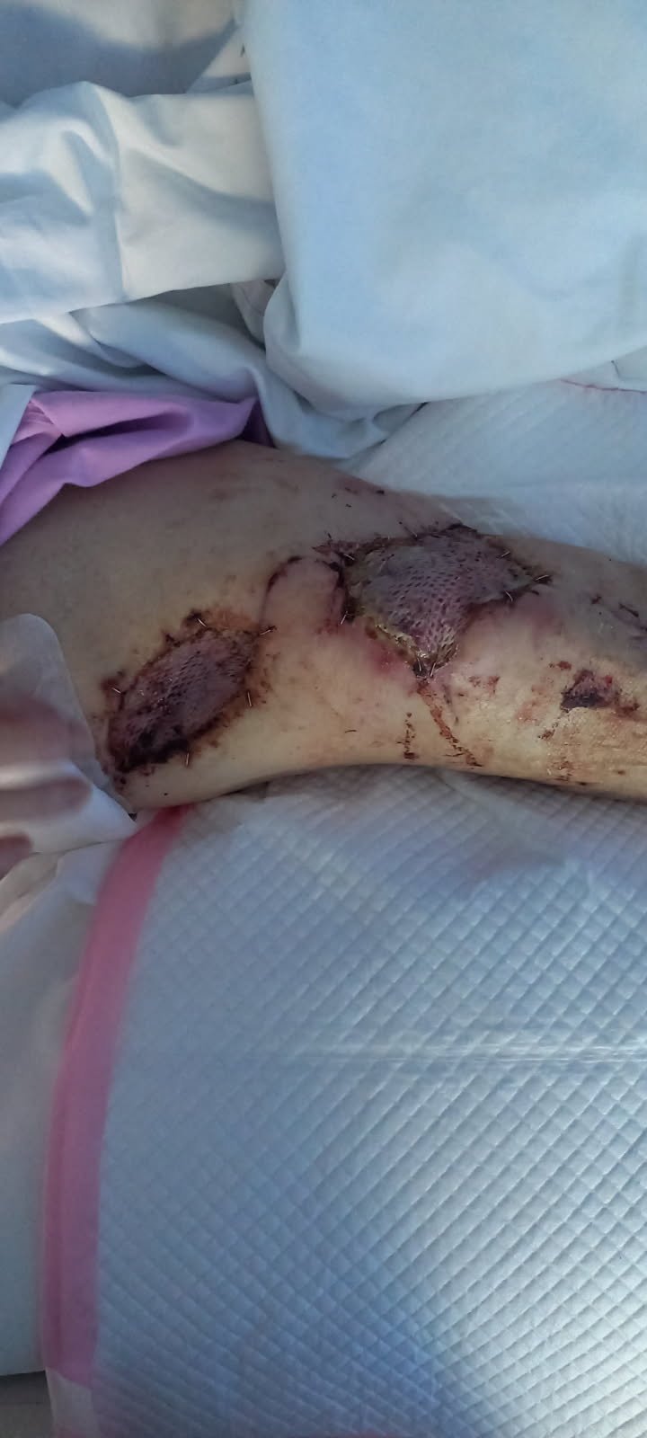 Ash is in hospital