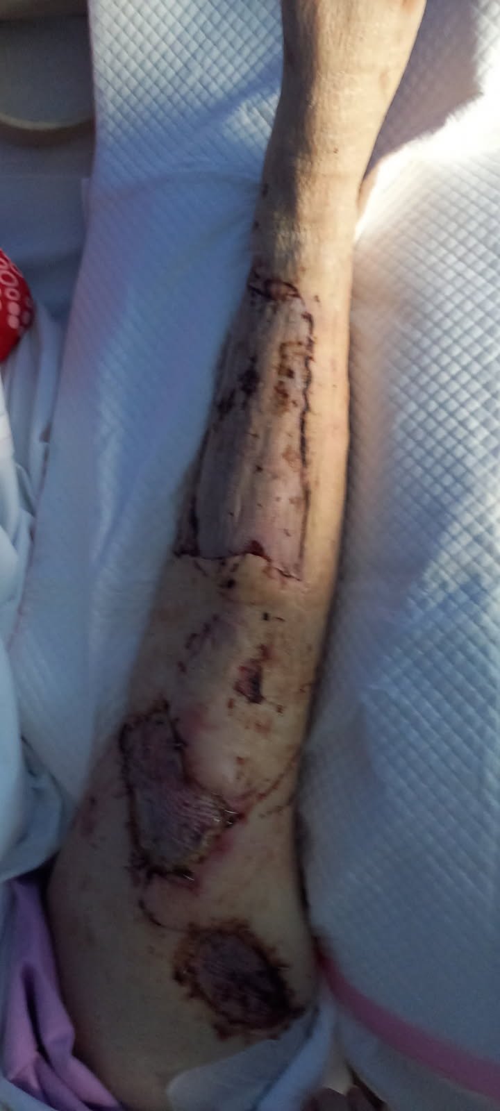 Ash is in hospital